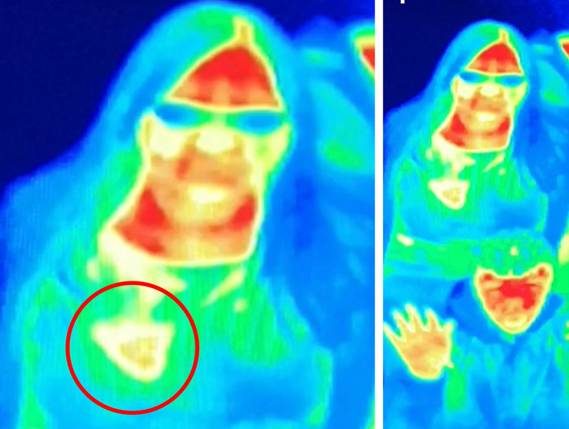 Heat Camera at Camera Obscura Helps Woman in Diagnosing Breast Cancer