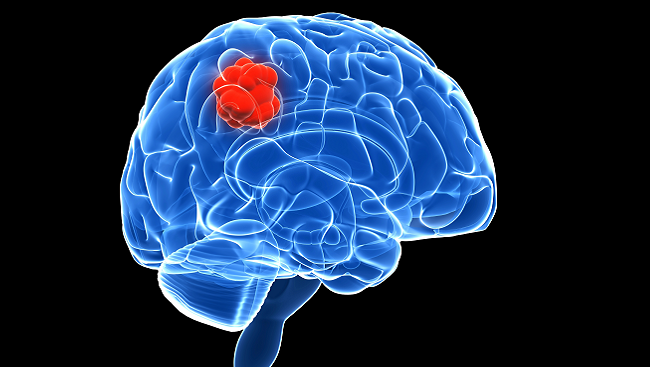 Scientists Discover Favorable Drug Merger Against Fatal Childhood Brain Cancers