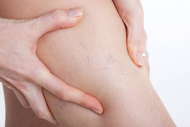 Treat Spider Veins With Sclerotherapy Fast